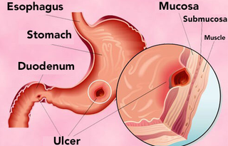 Illustration for article titled Obat Maag Tradisional Yang Ampuh